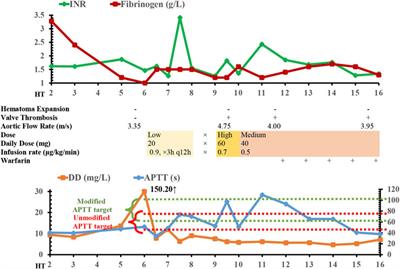 Anticoagulation Resumption in a Patient With Mechanical Heart Valves, Antithrombin Deficiency, and Hemorrhagic Transformation Following Thrombectomy After Ischemic Stroke